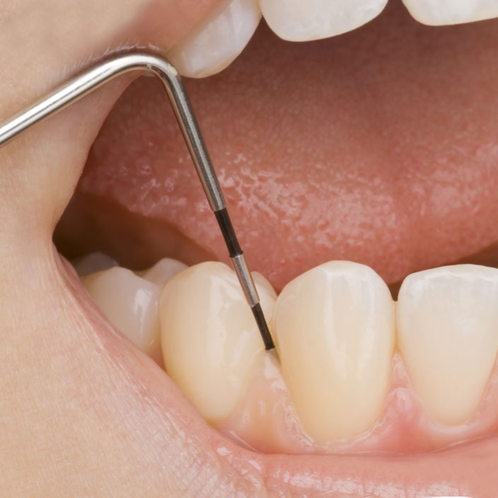 Diagnostik (Sondierung der Zahnfleischtaschen)